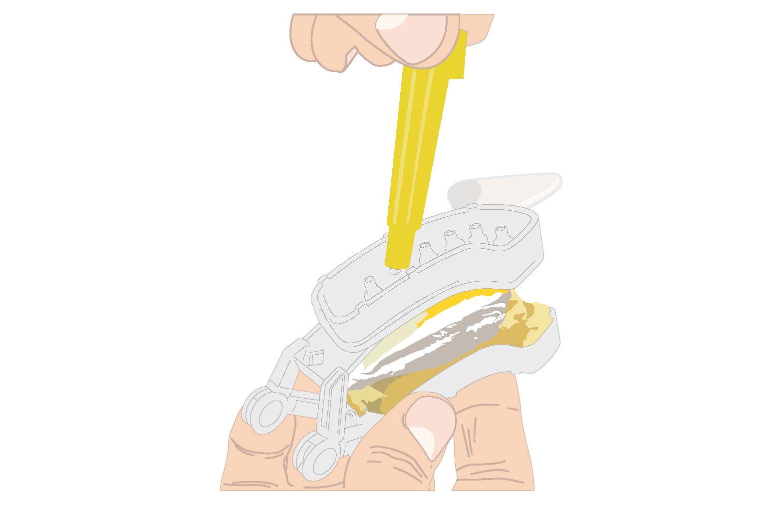Diamond Articualtor Pin Cap Removal Tool